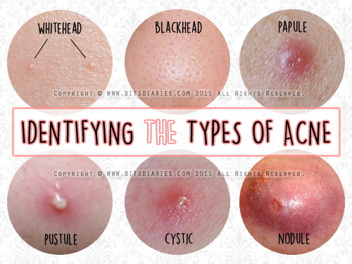 identifying types of acne.jpg