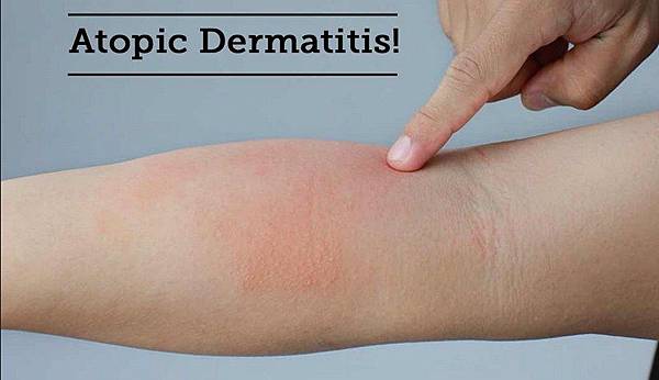 Atopic-dermatitis-causes.jpg