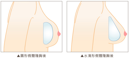 水滴形矽膠隆乳2