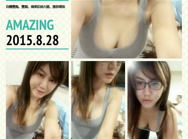 自體脂肪隆乳+Vaser威塑抽脂2