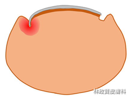 趾甲,凍甲,趾甲矯正,甲溝炎,嵌甲症,發炎,細菌感染