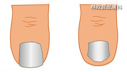 趾甲,凍甲,趾甲矯正,甲溝炎,嵌甲症,發炎,細菌感染