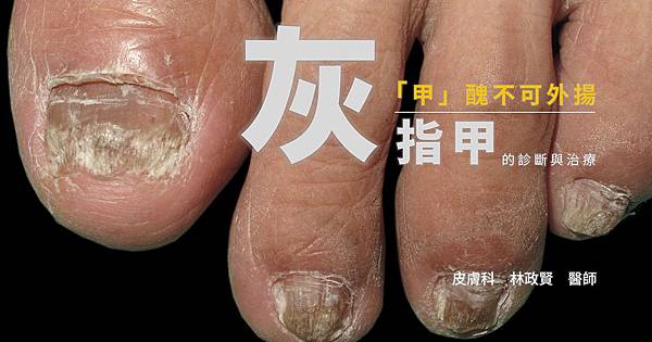 灰指甲,香港腳,嵌甲症,蜂窩性組織炎,蜂窩組織炎,足癬,黴菌感染,灰趾甲,甲癬,甲床剝離,臭甲,甲床分離,指甲變形,樂指利,loceryl,甲肉分離,指甲彩繪,美甲,terbinafine,itraconazole,lamisil,療黴舒,sporanox,適撲諾,amorolfine