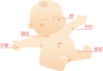 atopic-dermatitis