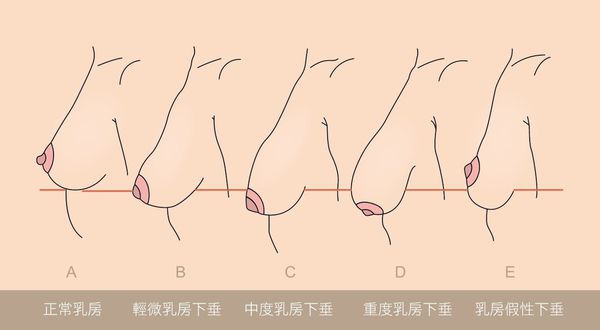 胸部下垂.jpg