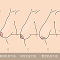 胸部下垂