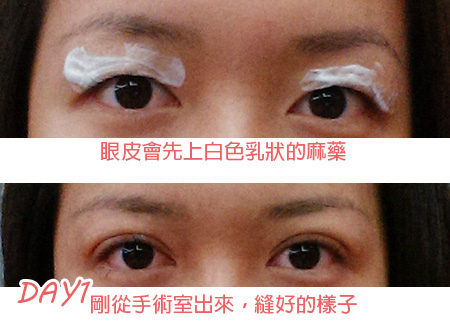 擺脫睫毛倒插的雙眼皮 台中信望愛眼科 小小的胡言亂語天地 痞客邦