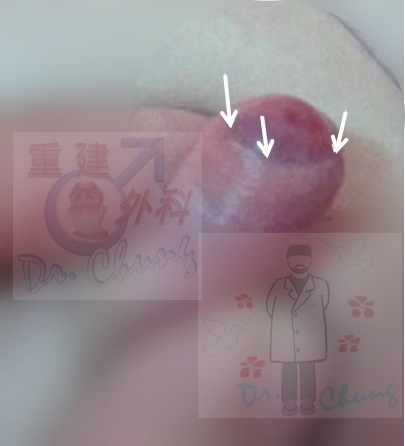 小孔包莖抹藥膏.jpg