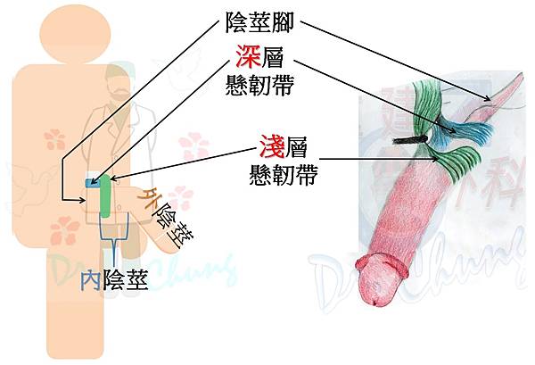 為什麼我們的陰莖增長術後不用陰莖拉伸器 (No penile