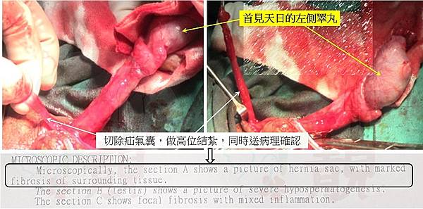 病理--疝氣囊.jpg