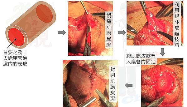 手術過程.jpg