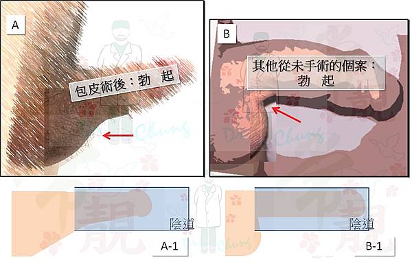 包皮術後.jpg