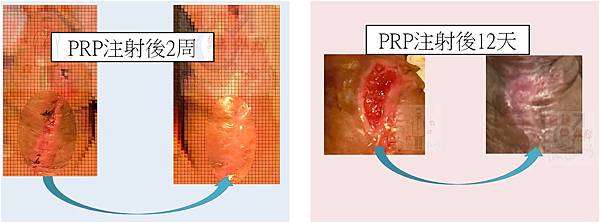 癒合不良傷口使用PRP的時間點—我的經驗(The clini