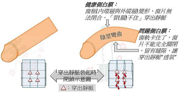 陰莖彎曲vs穿出靜脈.jpg