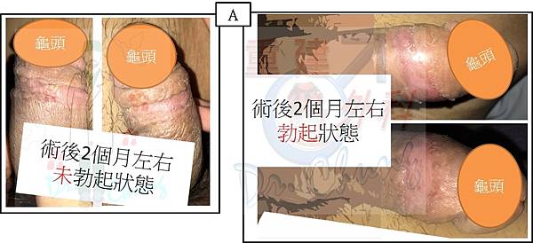 陰莖植皮復原歷程 (The healing process 