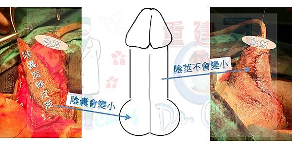 陰囊旋轉皮瓣術後.jpg