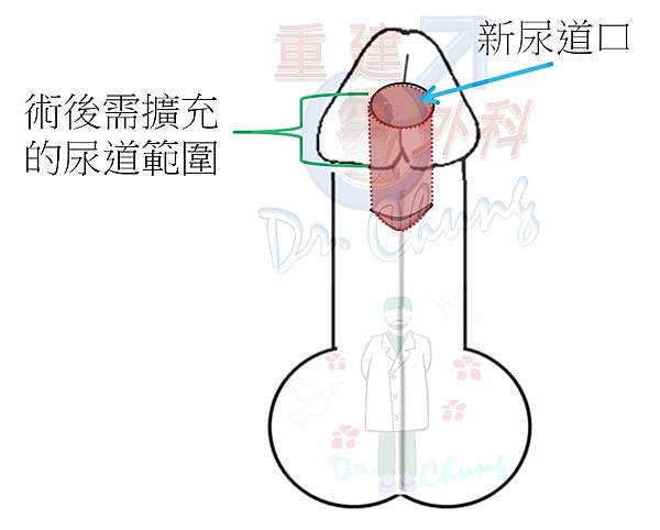 擴充尿道的範圍.jpg