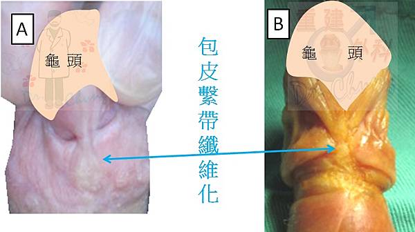 包皮繫帶的神經敏感問題探討(The hypersensiti