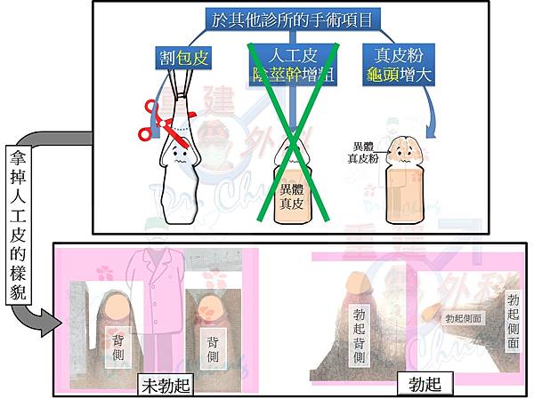 拿掉陰莖幹人工皮術後-1.jpg