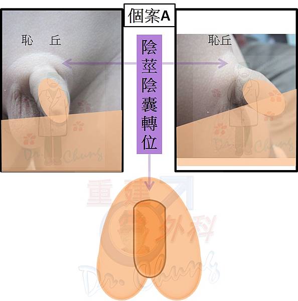 陰莖陰囊轉位-個案A.jpg