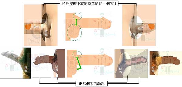 恥丘皮瓣增長-個案1-8VS正常陰莖.jpg