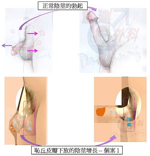 恥丘皮瓣增長-個案1-9VS正常陰莖.jpg