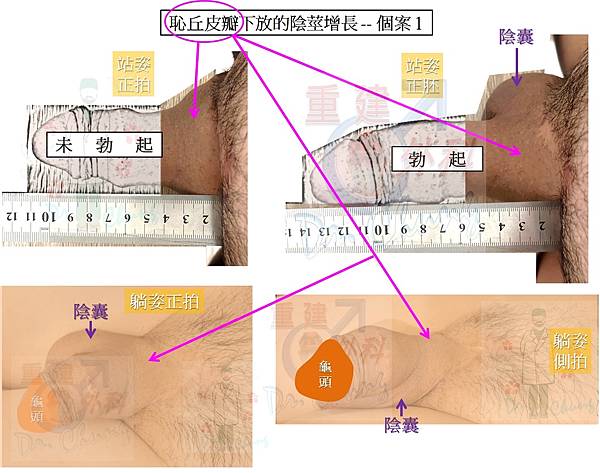 恥丘皮瓣增長-個案1-11.jpg