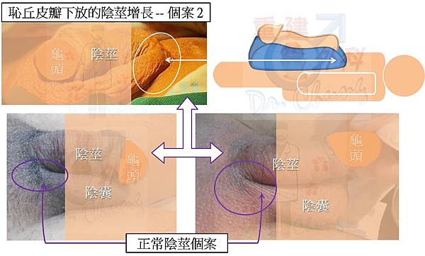 恥丘皮瓣增長-個案2-2.jpg