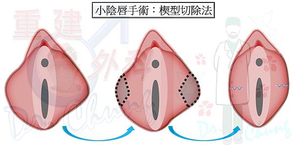 小陰唇手術-楔型切除法-1.jpg
