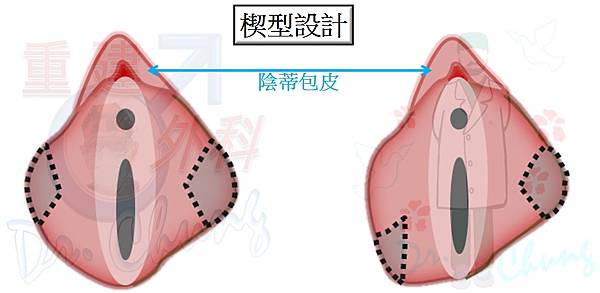 小陰唇手術-楔型切除法-2.jpg