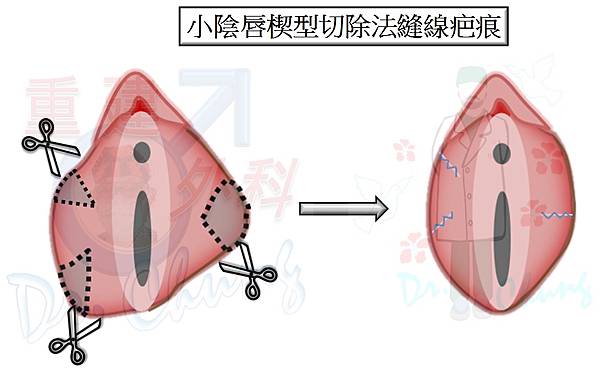 小陰唇手術-楔型切除法-3-疤痕.jpg