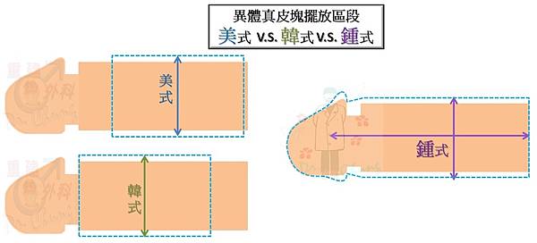 陰莖增大-韓式VS美式VS鍾式.jpg