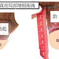 異體真局部皮陰莖增粗&割包皮術後-未勃起&勃起.jpg