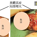 陰莖異體真皮局部增大.jpg
