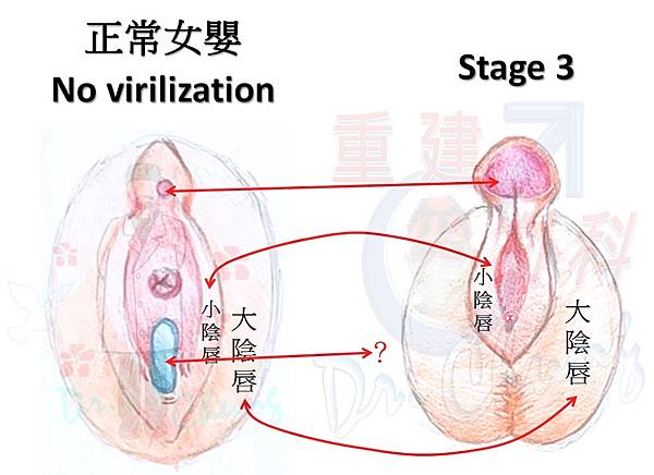陰蒂肥大-D-2.jpg