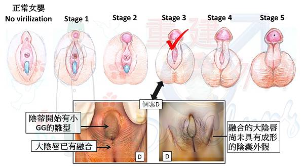 陰蒂肥大-D-1.jpg