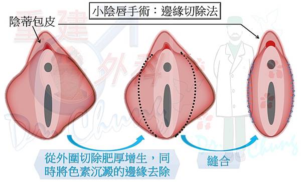 小陰唇手術-邊緣切除法-1.jpg