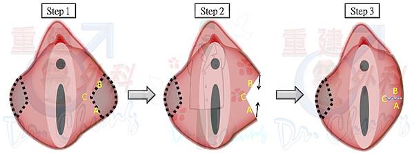 小陰唇手術-楔型切除法-4.jpg