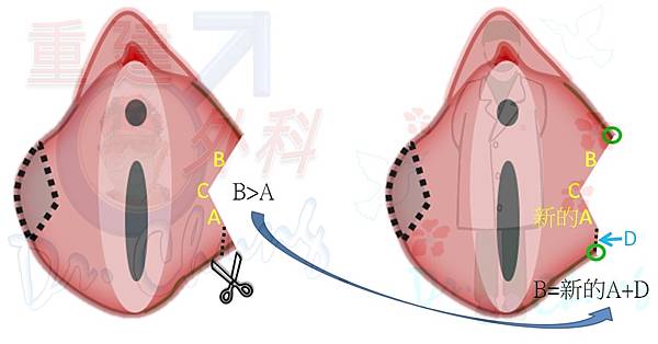 小陰唇手術-楔型切除法-6.jpg