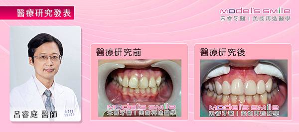 【台北牙醫 星鑽超薄瓷牙貼片案例】 超薄貼片打擊泛黃歪門牙 笑容滿面轉職更順利