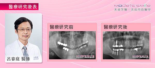 【台北牙醫雷射微創植牙案例】牙周發炎又缺牙 影響新婚婦受孕品質