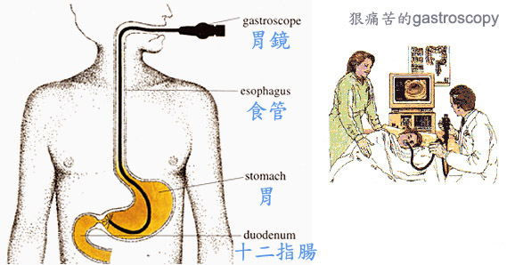 照胃鏡 照胃鏡
