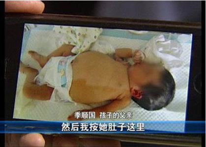 女嬰懷了胎中胎 初生嬰罕見啤酒肚