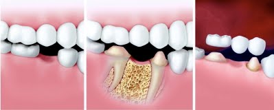 dental-bridge-steps.jpg