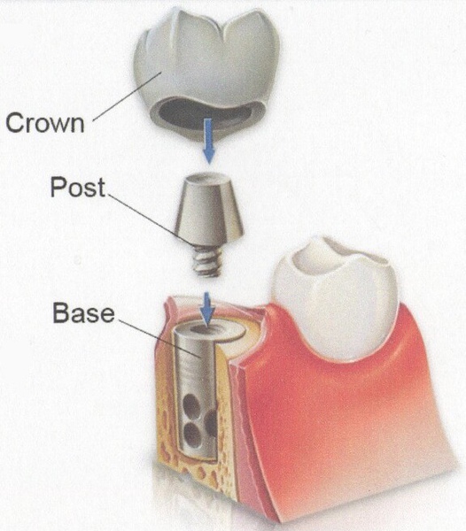 Tooth-Implant.jpg