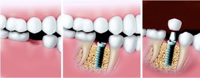 dental-implant-steps.jpg