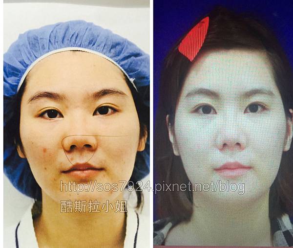 張簡仕煌醫生韓式隆鼻真實案例韓式娃娃鼻縮鼻翼敲鼻骨gortex Godzilla 酷斯拉小姐愛漂亮人生 痞客邦