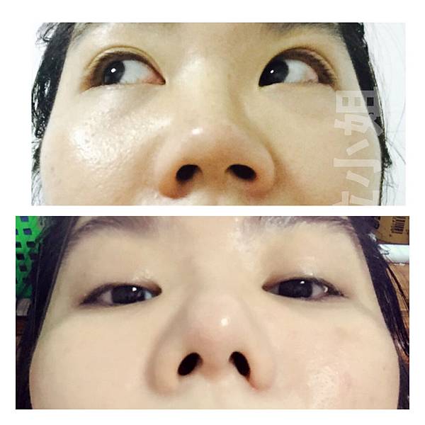 張簡仕煌醫生韓式隆鼻真實案例韓式娃娃鼻縮鼻翼敲鼻骨gortex Godzilla 酷斯拉小姐愛漂亮人生 痞客邦