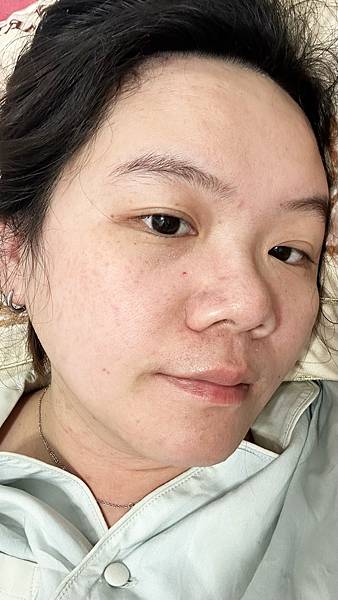 【醫美】除斑細緻毛孔推薦～台北愛爾麗診所分享-蜂巢皮秒心得分