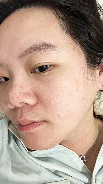 【醫美】除斑細緻毛孔推薦～台北愛爾麗診所分享-蜂巢皮秒心得分